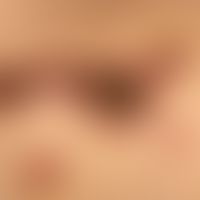 Kollagenose, reaktive perforierende:&nbsp;Detailaufnahme. &nbsp;Ältere und jüngere Effloreszenzen...