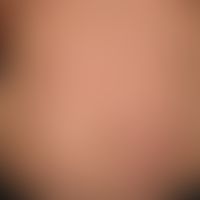 drug exanthema, maculo-papular. multiple, acute, for 5-6 days existing, generalized, symmetrical,...