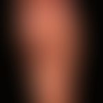 Dyshidrotische Dermatitis: chronisch rezidivierende,&nbsp; hyperkeratotische&nbsp;Dermatitis an H...