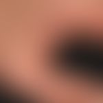 Hand-Fuß-Mund-Krankheit:&nbsp;seit etwa 1 Woche, &nbsp;schmerzhafte, Bläschen,Pusteln und Papeln&...