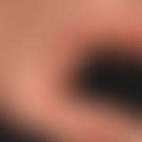 Hand-Fuß-Mund-Krankheit:&nbsp;seit etwa 1 Woche, &nbsp;schmerzhafte, Bläschen,Pusteln und Papeln&...