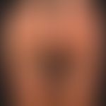 HanHand-Fuß-Mund-Krankheit:&nbsp;seit etwa 1 Woche, &nbsp;schmerzhafte, Bläschen,Pusteln und Pape...