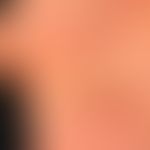 Hand-Fuß-Mund-Krankheit:&nbsp;seit etwa 1 Woche, &nbsp;schmerzhafte, Bläschen,Pusteln und Papeln&...