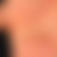 Hand-Fuß-Mund-Krankheit:&nbsp;seit etwa 1 Woche, &nbsp;schmerzhafte, Bläschen,Pusteln und Papeln&...