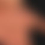 Hand-Fuß-Mund-Krankheit:&nbsp;seit etwa 1 Woche, &nbsp;schmerzhafte, Bläschen,Pusteln und Papeln&...
