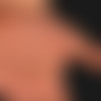 Hand-Fuß-Mund-Krankheit:&nbsp;seit etwa 1 Woche, &nbsp;schmerzhafte, Bläschen,Pusteln und Papeln&...