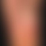 Hand-Fuß-Mund-Krankheit:&nbsp;seit etwa 1 Woche, &nbsp;schmerzhafte, Bläschen,Pusteln und Papeln&...