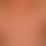 Gynecomastia: pronounced enlargement of the mammae in a 68-year-old male patient. moderate obesit...