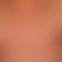 Gynecomastia: pronounced enlargement of the mammae in a 68-year-old male patient. moderate obesit...