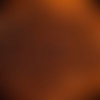 nevus, melanocytic, congenital in colored skin: incident light microscopy. symptomless plaque exi...
