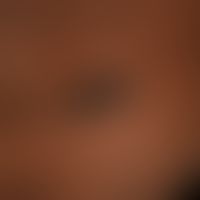 Nevus, melanocytic, congenital, shown here in colored skin, solitary, brown-black, surface smooth...