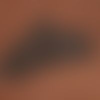 Nevus, melanocytic, congenital. shown here in colored skin. detailed view. solitary, brown-black,...