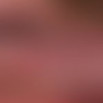 Lichen planus mucosae: non-erosive lichen planus of the oralmucosa; only low local "sensitivity" ...