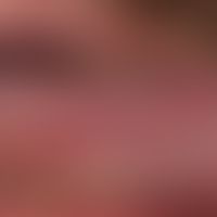 Lichen planus mucosae: non-erosive lichen planus of the oralmucosa; only low local "sensitivity" ...