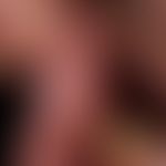 Lichen planus mucosae: small, white or opalescent spots and papules of the buccal mucosa, which c...