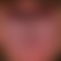 Lichen planus mucosae: white-grey plaques that have been present for several months, with an infl...