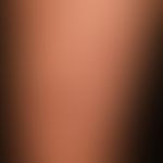 Dermatosis, acute febrile neutrophilic. reddish-livid, succulent, pressure-dolent, infiltrated, p...