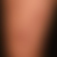 Dermatosis, acute febrile neutrophilic. reddish-livid, succulent, pressure-dolent, infiltrated, p...