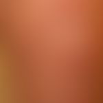 Dermatosis, acute febrile neutrophilic. reddish-livid, succulent, pressure-dolent, infiltrated, p...