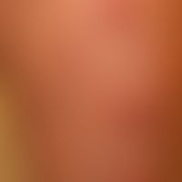 Dermatosis, acute febrile neutrophilic. reddish-livid, succulent, pressure-dolent, infiltrated, p...