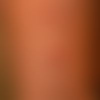 Dermatosis, acute febrile neutrophils (Sweet syndrome):suddenly opened generalized clinical pictu...
