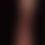 Ulcus cruris venosum: Large, therapy-resistant (almost circumferential) venous leg ulcer with pyo...