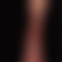 Ulcus cruris venosum: Large, therapy-resistant (almost circumferential) venous leg ulcer with pyo...