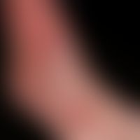 Vegetative pyoderma of the back of the foot in the case of a previously known, long-standing veno...