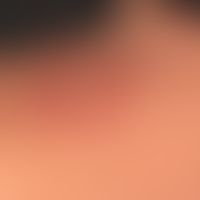 Lupus erythermatodes tumidus:recurrent disease patternforseveral years. no itching, no other subj...