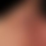 Endocrine orbitopathy: known immunogenic hyperthyroidism (Graves' disease) with distinct exophtha...