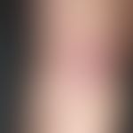 Lyme borreliosis: Erythema chronicum migrans, which has been present for several weeks, continues...