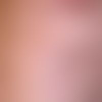 Transitorische akantholytische Dermatose (M.Grover): seit wenigen Wochen bestehendes, kaum&nbsp; ...