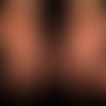 erythema multiforme: post-herpetic erythema multiforme. here a healing phase with coarse lamellar...