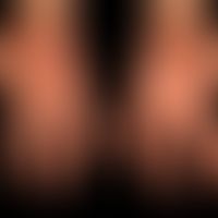 Erythema multiforme: postherpetisches Erythema multiforme. Hier eine Abheilungsphase&nbsp;mit gro...