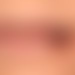 Herpes simplex recidivans:&nbsp;Abheilungsphase eines rezidivierenden Lippenherpes.&nbsp;

