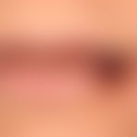 Herpes simplex recidivans:&nbsp;Abheilungsphase eines rezidivierenden Lippenherpes.&nbsp;
