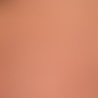 Striae cutis distensae (buttocks). initial blue-reddish (Striae rubrae), later whitish, very fine...