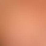 Transitorische akantholytische Dermatose (M.Grover):&nbsp;62-Jahren alter Patient;&nbsp; seit wen...