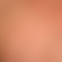 Transitorische akantholytische Dermatose (M.Grover):&nbsp;62-Jahren alter Patient;&nbsp; seit wen...