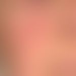 Nummuläre Dermatitis: Seit mehreren Monaten bestehendes, ausgedehntes, Ekzem mit unscharf begrenz...