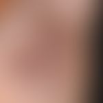 Acne inversa. Multiple, chronisch stationäre, intertriginös lokalisierte, rot-braune, wulstige Na...