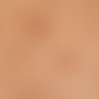 Syringome disseminated: detailed view; since about 2 years, imperceptibly multiplying, disseminat...