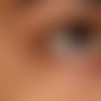 Syringome disseminierte:&nbsp;an Rumpf und im Gesichtsbereich lokalisierte, hautfarbene bis leich...