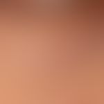 Syringoma: up to 0.2 cm in size, disseminated, oval to elongated, completely asymptomatic, surfac...