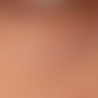 Syringoma: up to 0.2 cm in size, disseminated, oval to elongated, completely asymptomatic, surfac...