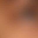Syringoma: up to 0.2 cm in size, disseminated, oval to elongated, completely asymptomatic, surfac...