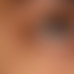 Syringoma: up to 0.2 cm in size, disseminated, oval to elongated, completely asymptomatic, surfac...