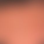 Sklerodermie en coup de sabre: seit Jahren langsam sich vergrößernde, symptomlose, lineare, haarl...