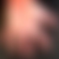 Hand-Fuß-Mund-Krankheit:&nbsp;seit etwa 1 Woche, &nbsp;schmerzhafte, Bläschen, Blasen&nbsp; und P...