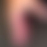 Hand-Fuß-Mund-Krankheit:&nbsp;seit etwa 1 Woche, &nbsp;schmerzhafte, Bläschen, Blasen&nbsp; und P...